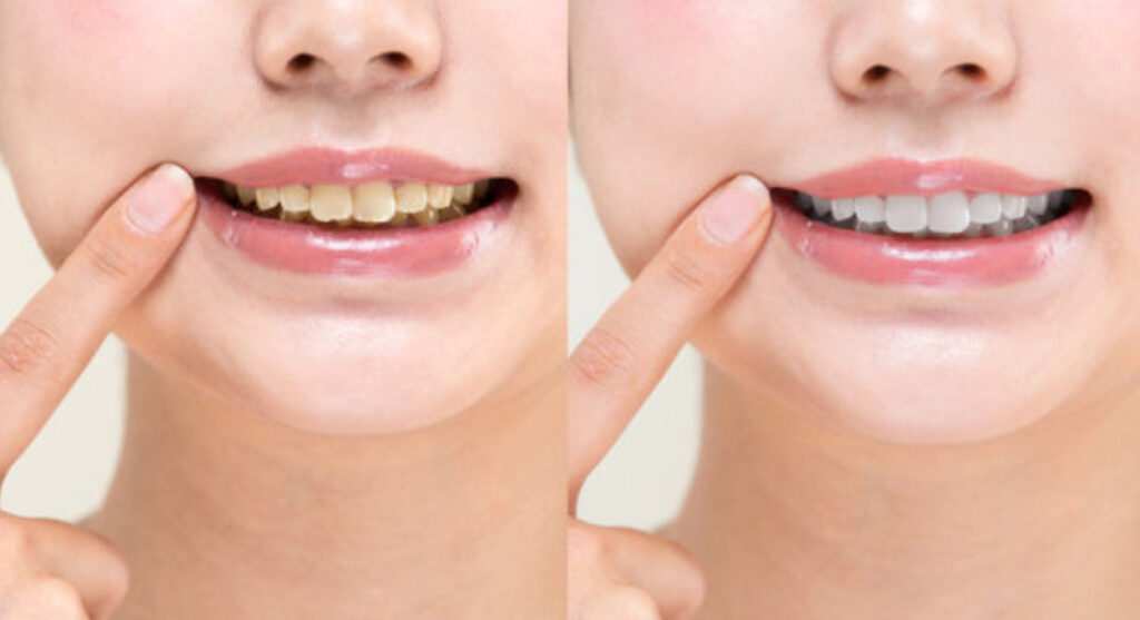 セルフホワイトニング